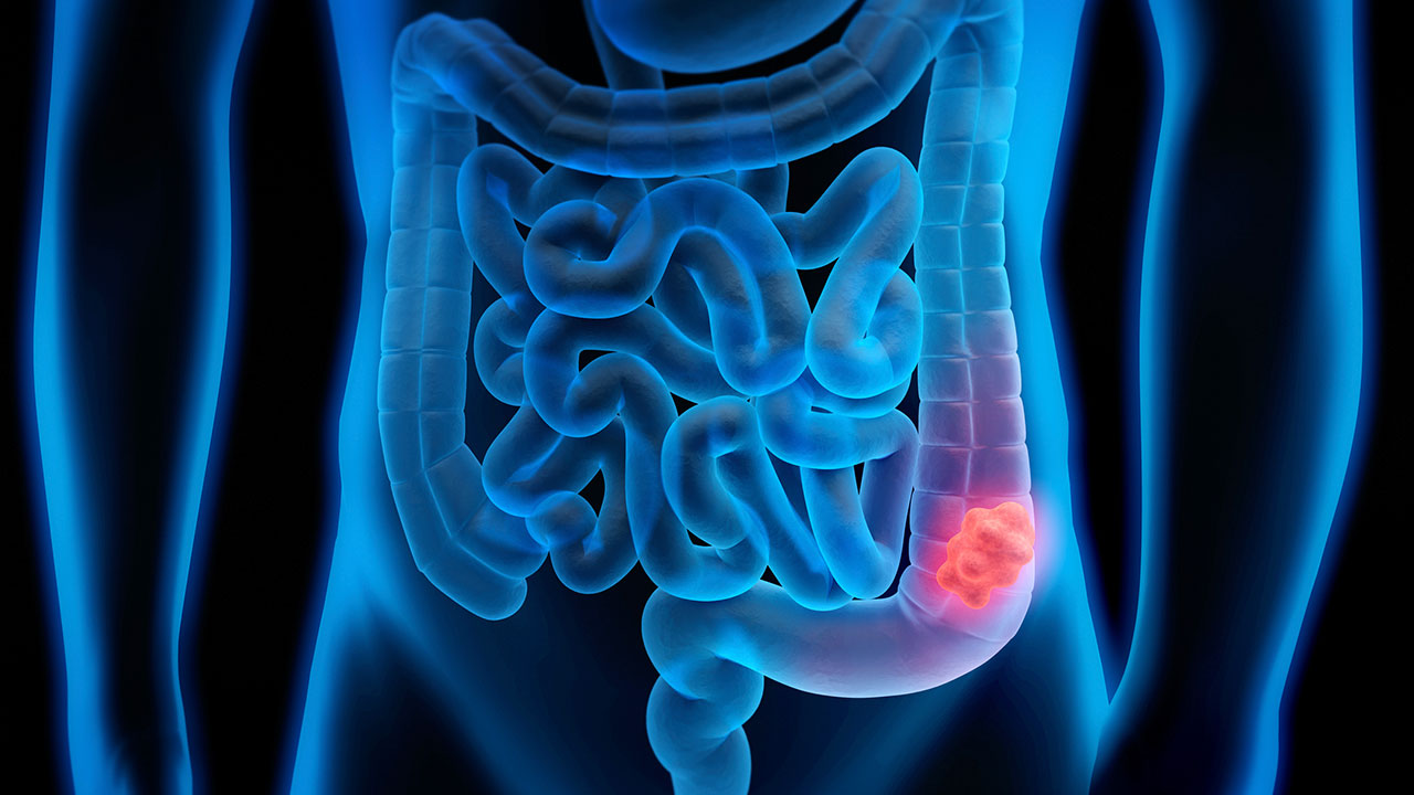Un modelo matemático identifica las estrategias idóneas para la detección precoz del cáncer colorrectal